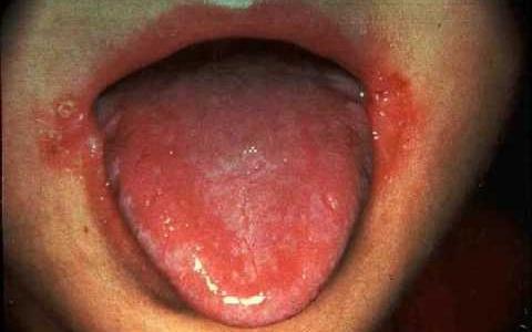 Les symptômes et les signes de la stomatite chez les enfants