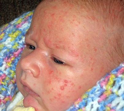 Allergies chez un nourrisson