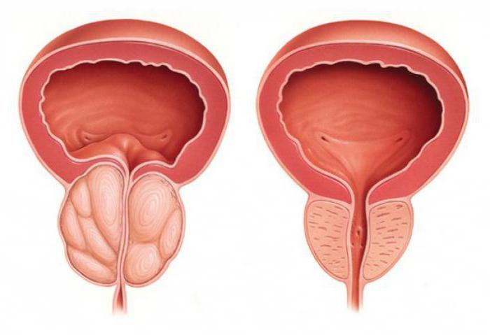 Écorce de peuplier faux-tremble avec adénome de la prostate: propriétés médicinales, recettes, avis
