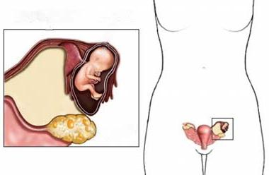 kyste de l'ovaire pendant la grossesse